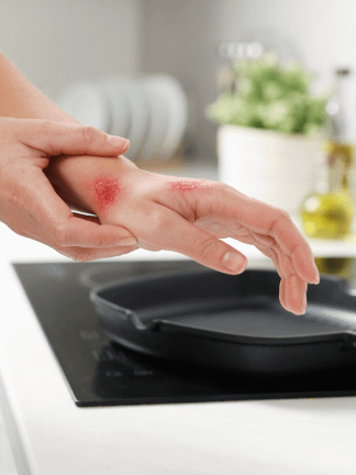 Basics of Burns and Their Treatments