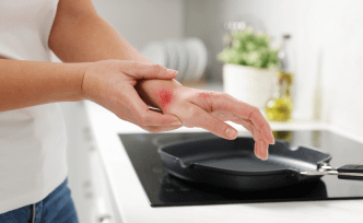 Basics of Burns and Their Treatments