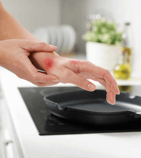 Basics of Burns and Their Treatments